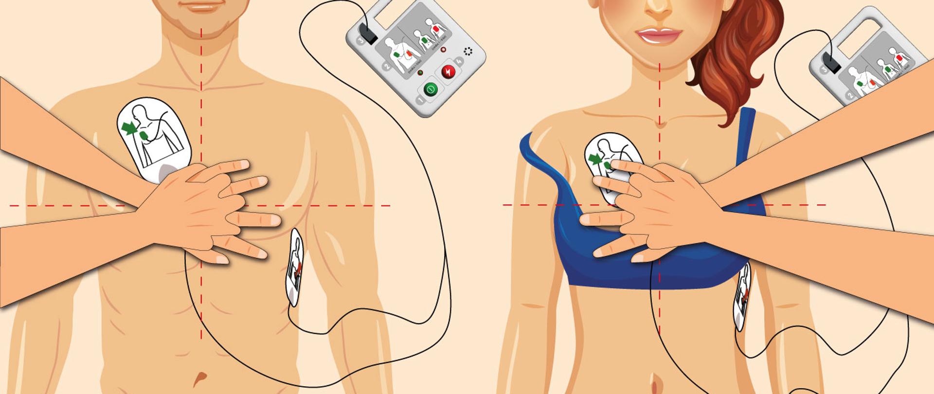 AED – jak używać defibrylatora automatycznego? Instrukcja krok po kroku