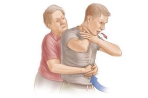 Zadławienie - Pierwsza Pomoc